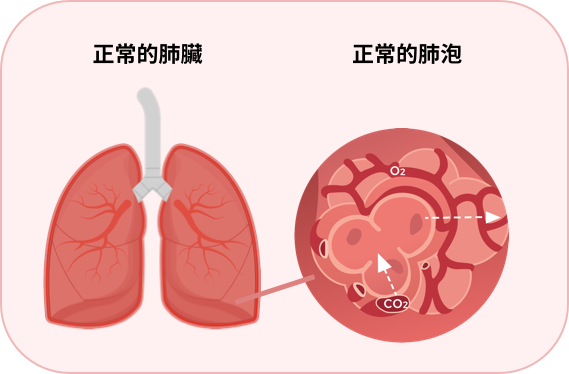 正常的肺臟和肺泡