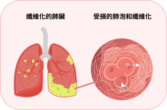 肺纖維化的肺臟和肺泡